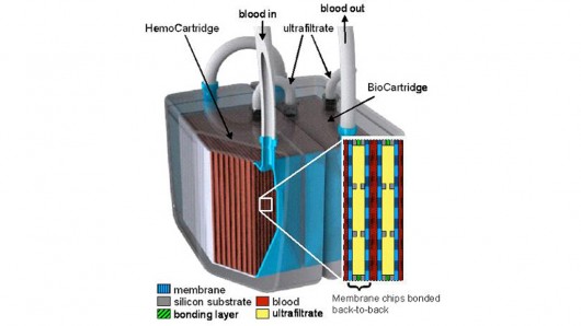 A model of the implantable bioartificial kidney shows the two-stage system
