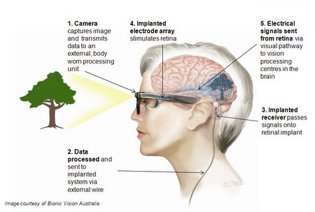 How BVA's retinal implant works (Image: BVA)