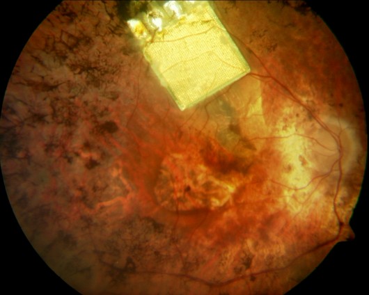 Retinal implant installed in an eye (Image: Retinal Implant AG)