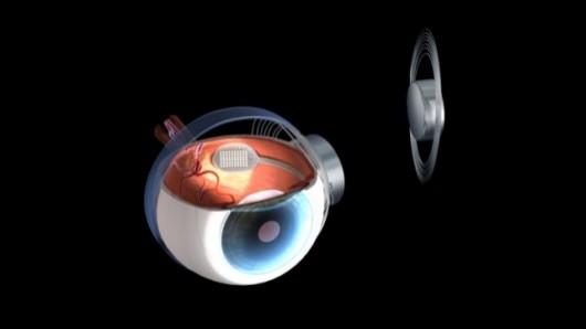 A clinical trial of the Argus II Retinal Prosthesis involving 30 patients has produced enc...