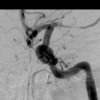 Angiogram of cerebral blood vessel after Solitaire treatment (Image: Covidien)