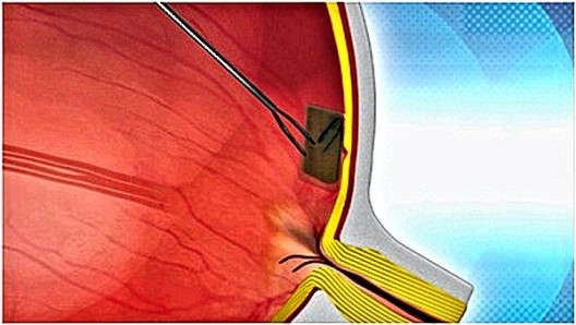 Drawing of a Bio-Retina being inserted into an eye and affixed to the AMD damaged retina b...