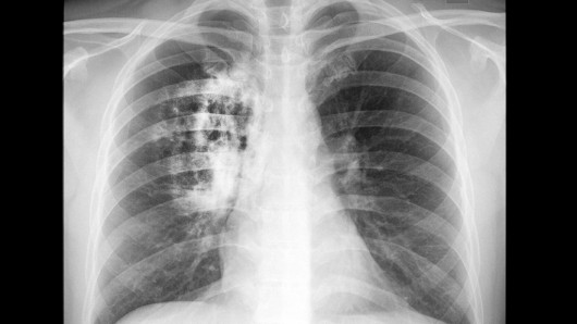 Findings that a variant of the CIZ1 protein is present in lung cancers could lead to the d...