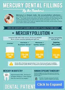 dental fillings infographic