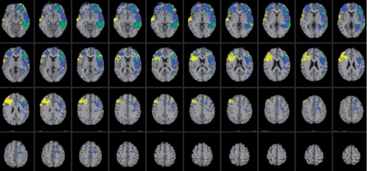 CT scan showing overlaps of different general and emotional intelligence functions