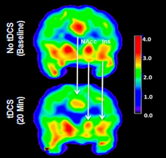 PET scan of a patient's brain before and after tDCS stimulation with red and yellow showin...