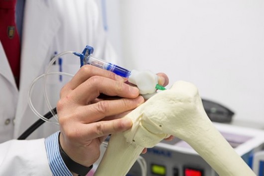 The BioPen allows a physician to heal bones faster by depositing stem cells, scaffolding, ...