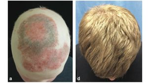 Image: Arthritis Drug Spurs Hair Growth - Lots of It