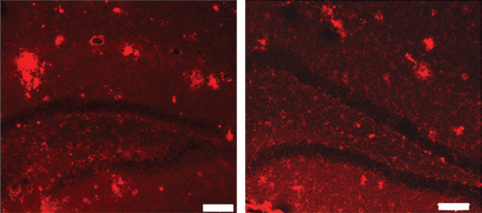 The plaque abnormalities on untreated transgenic mice (left) and the brain of a transgenic...