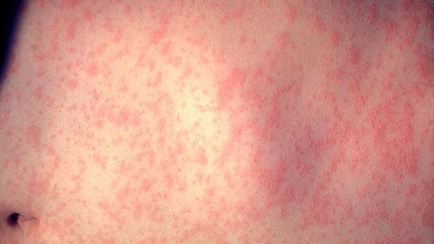 Skin of a patient after 3 days of measles infection. (CDC)