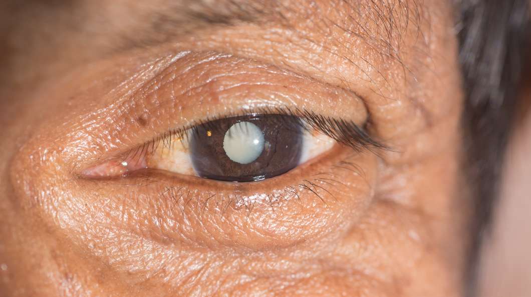 Research suggests that treating cataracts by way of an eye drop mightn't be all that far away