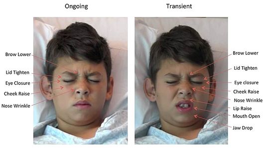Examples of a childs facial expressions of pain from the study, illustrating many of the core facial actions observed in pain