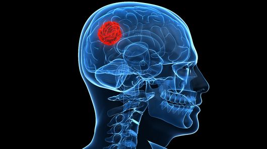 A molecule known as UCD38B could find use in the treatment of brain cancer (Image: Shutterstock)