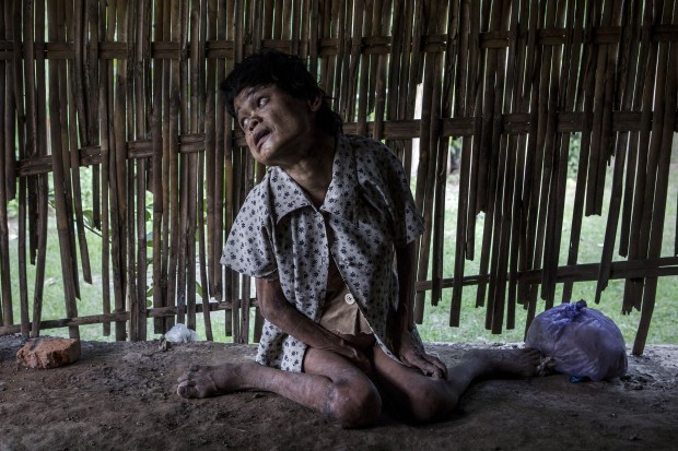 Down syndrome sufferer Sinem, who is paralyzed, mute and deaf, sits in front of their house at Krebet Village in Jambon subdistrict on March 23, 2016 in Ponorogo district, Indonesia. (Photo by Ulet Ifansasti/Getty Images)