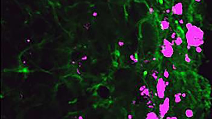 Reprogrammed stem cells (green) chase down and kill glioblastoma cells (pink)