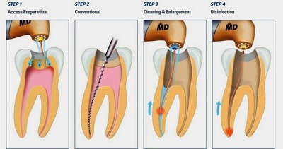 root-canal-therapy_tn