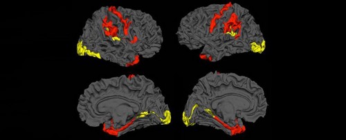 schizophrenia_1024_tn