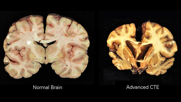 A normal brain, as compared to one with advanced chronic traumatic encephalopathy