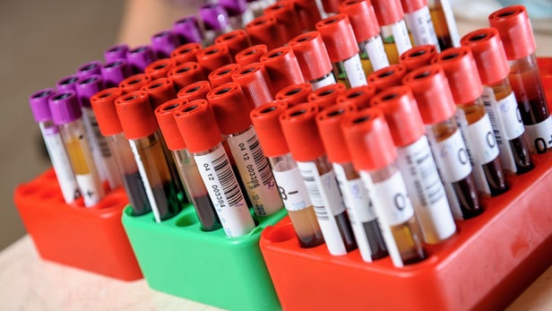 A blood test for Alzheimer's could prove invaluable in detecting the disease early on