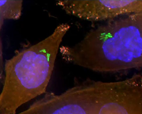 Bacteria (green) inside human pancreatic cancer cells (AsPC-1 cells). The cells nuclei are stained blue while...